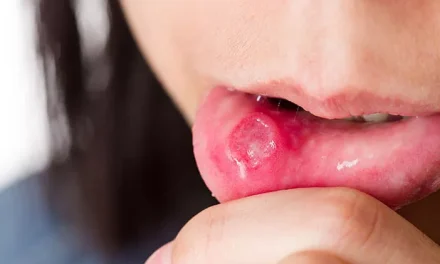 Ulcus Mulut Atau Sariawan Yang Membuat Susah Makan