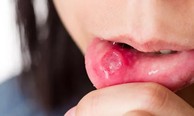 Ulcus Mulut Atau Sariawan Yang Membuat Susah Makan