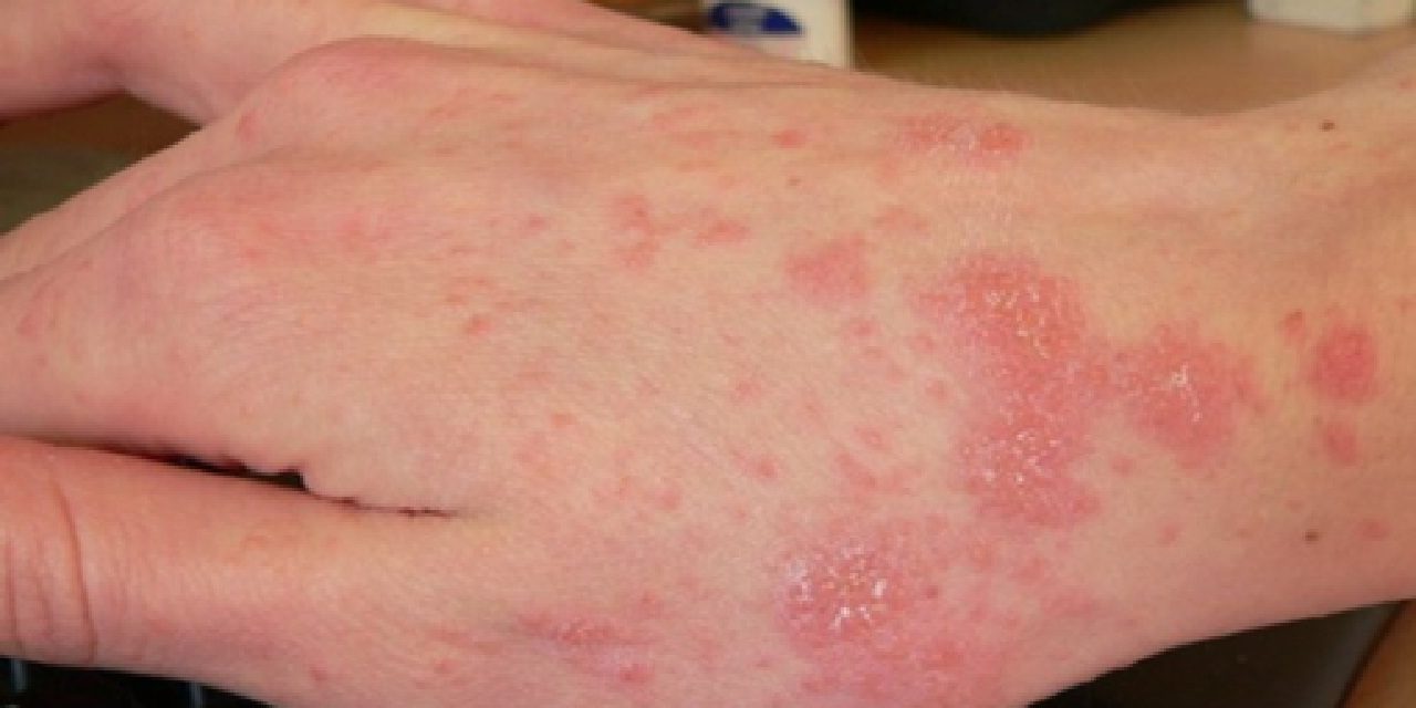 Penyakit Menular Scabies Yang Terjadi Pada Kulit