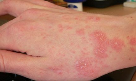 Penyakit Menular Scabies Yang Terjadi Pada Kulit