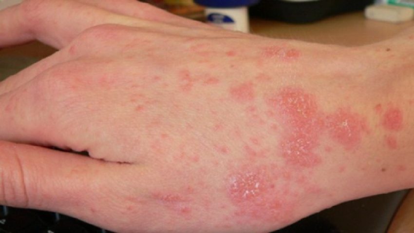 Penyakit Menular Scabies Yang Terjadi Pada Kulit