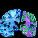 Kondisi Penyerangan Otak Pada Penyakit Alzheimer
