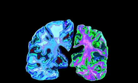 Kondisi Penyerangan Otak Pada Penyakit Alzheimer