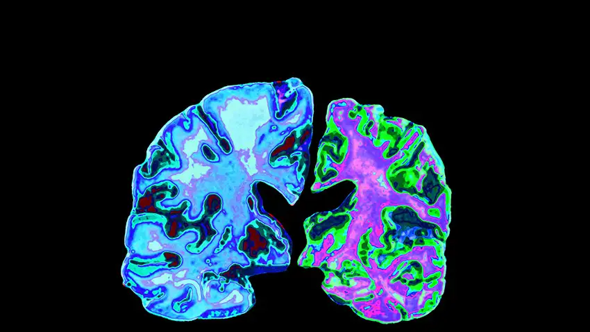 Kondisi Penyerangan Otak Pada Penyakit Alzheimer